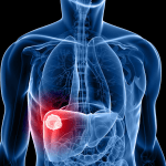 Liver cancer cases rising due to preventable factors