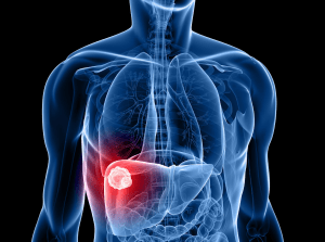 Liver cancer cases rising due to preventable factors